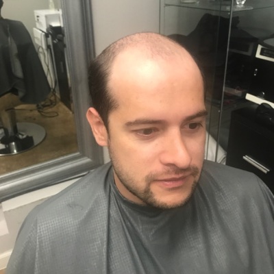 2 Chemo Related Hair Replacement