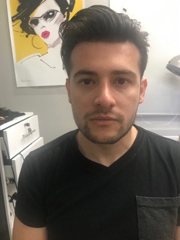 Hair Replacement Success Stories 2 Ralph .R After