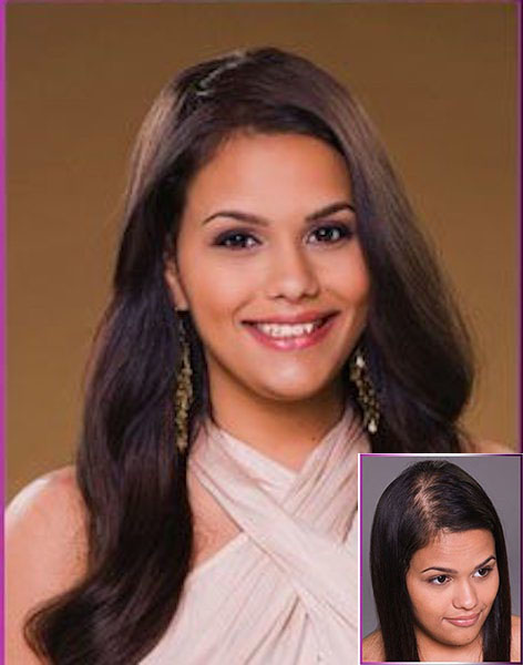 Cindy 2 Hair Restoration For Women