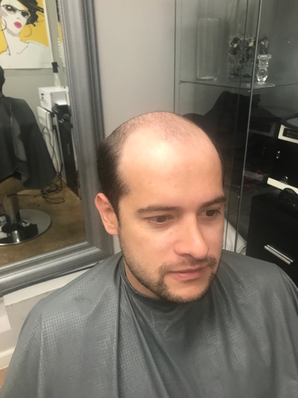 Hair Replacement Success Stories 1 Ralph .R Before