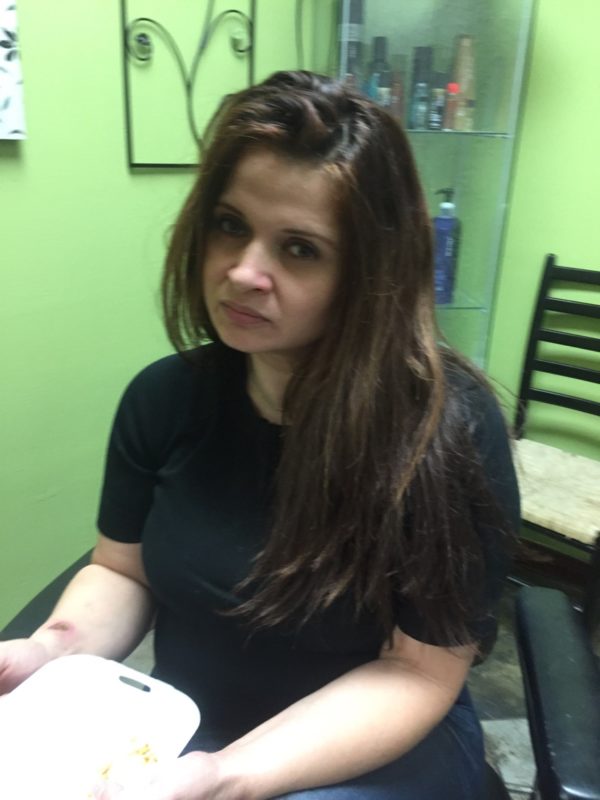 Hair Replacement Success Stories 8 Elisa After