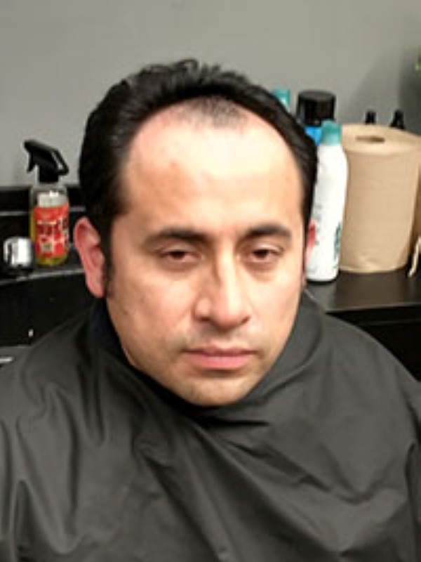 Hair Replacement Success Stories 13 Irwin Before