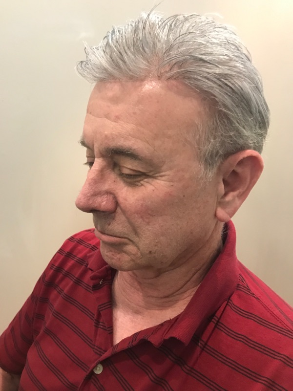 Hair Replacement Success Stories 11 Joseph.K After