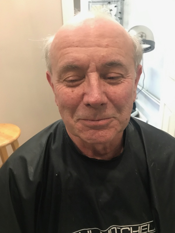 Hair Replacement Success Stories 10 Joseph.K Before