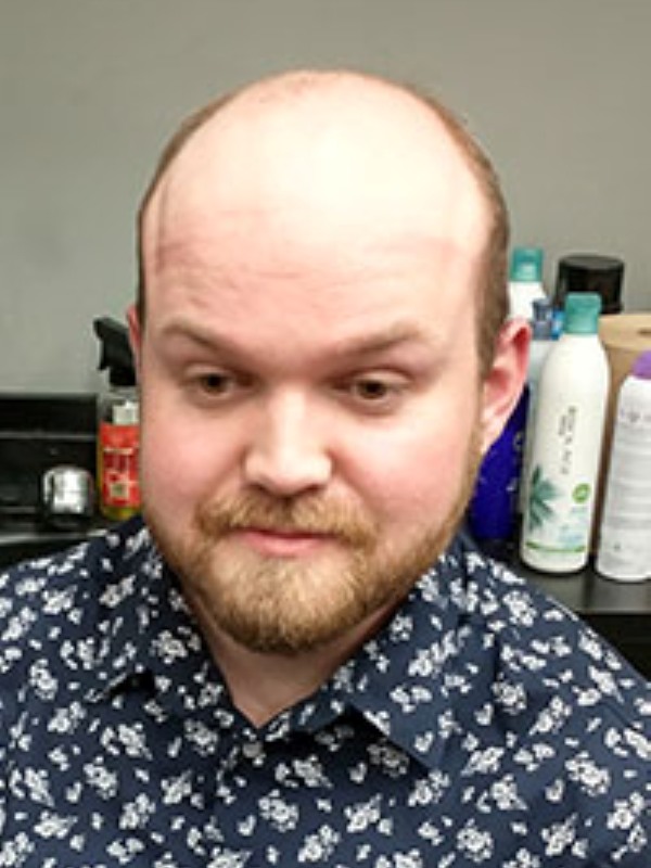 Hair Replacement Success Stories 16 Kurtis Before