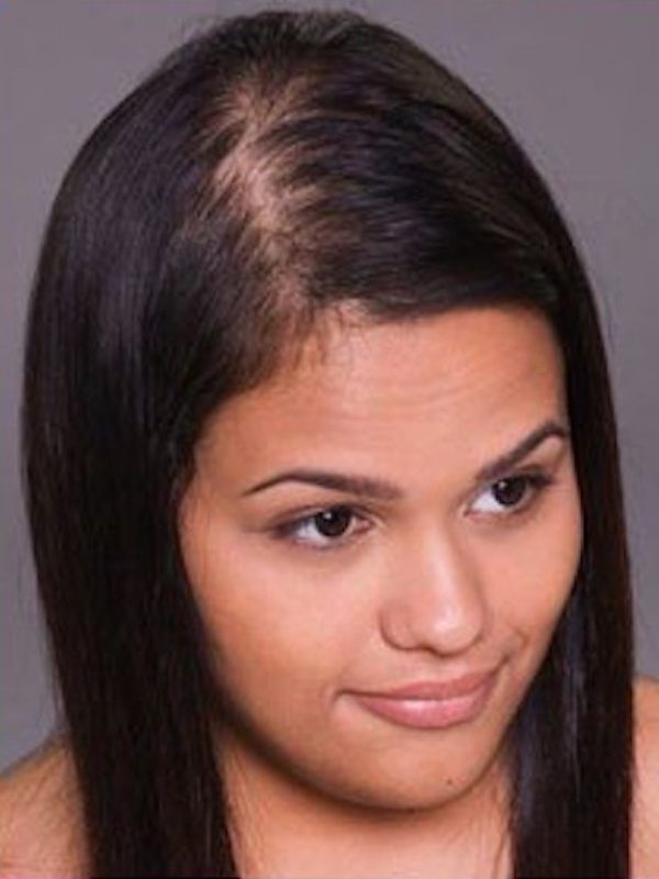 Hair Replacement Success Stories 4 Natalie Before