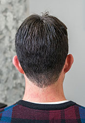Hair Replacement