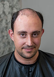 Hair Replacement