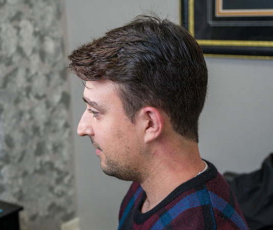 Hair Replacement