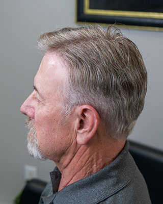 john 250 200 front Hair Restoration For Men