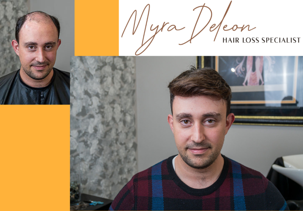 Common Questions About Non-Surgical Hair Replacement Systems 1 Non-Surgical Hair Replacement System Questions