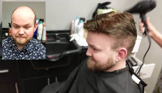 Kurtis Final500 300 Free Hair Replacement Consultation