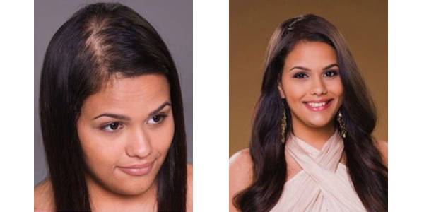 Natalie showing her thinning hair and after she gets her hair back at md hair design