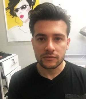Ralph 300 pic1 Hair Restoration For Men
