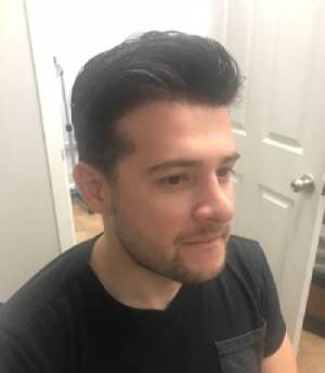Ralph after 300 pic2 Hair Restoration For Men