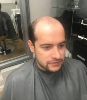 Ralph before he gets his hair back at md hair design
