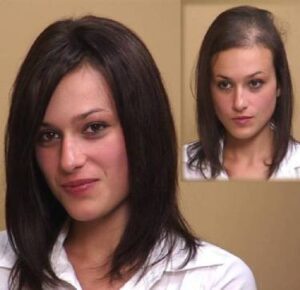 Kate showing her before and after hair loss