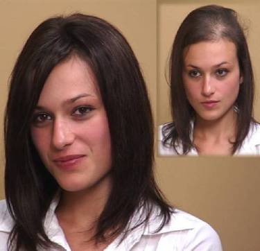 Kate showing her before and after hair loss